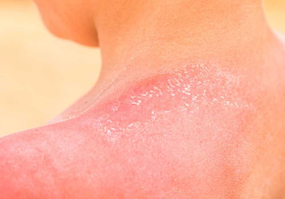Can You Get Sunburned On A Cloudy Day Secrets to Protecting Yourself