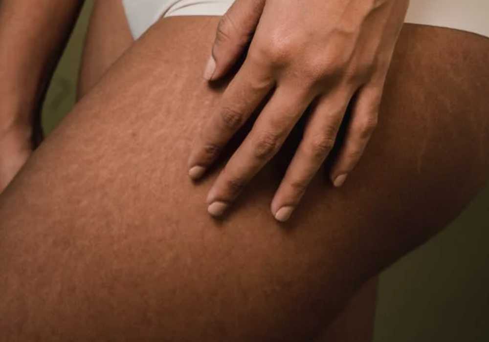 Svag Umulig Christchurch Does Spray Tan Cover Stretch Marks? Here Is How To Do It - Tanner Skin