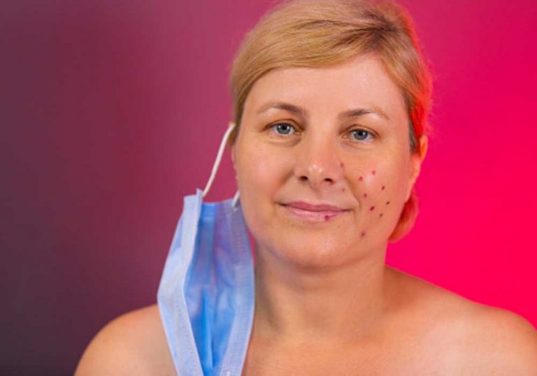 Tanning Bumps How To Prevent Itchy Red Tanning Bed Bumps Tanner Skin