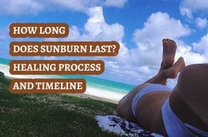 How Long Does Sunburn Last